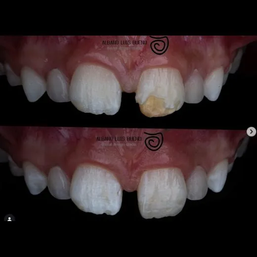 Antes e depois