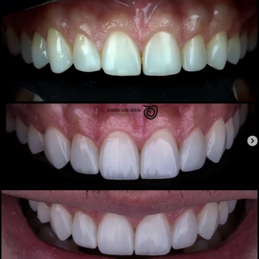Antes e depois