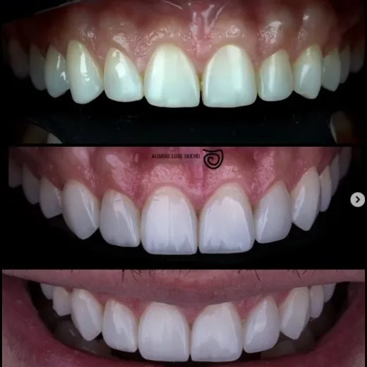 Antes e depois
