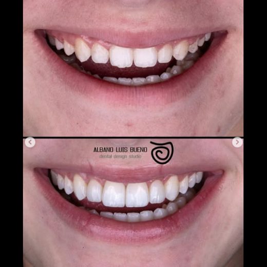 Antes e depois