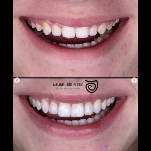 Antes e depois